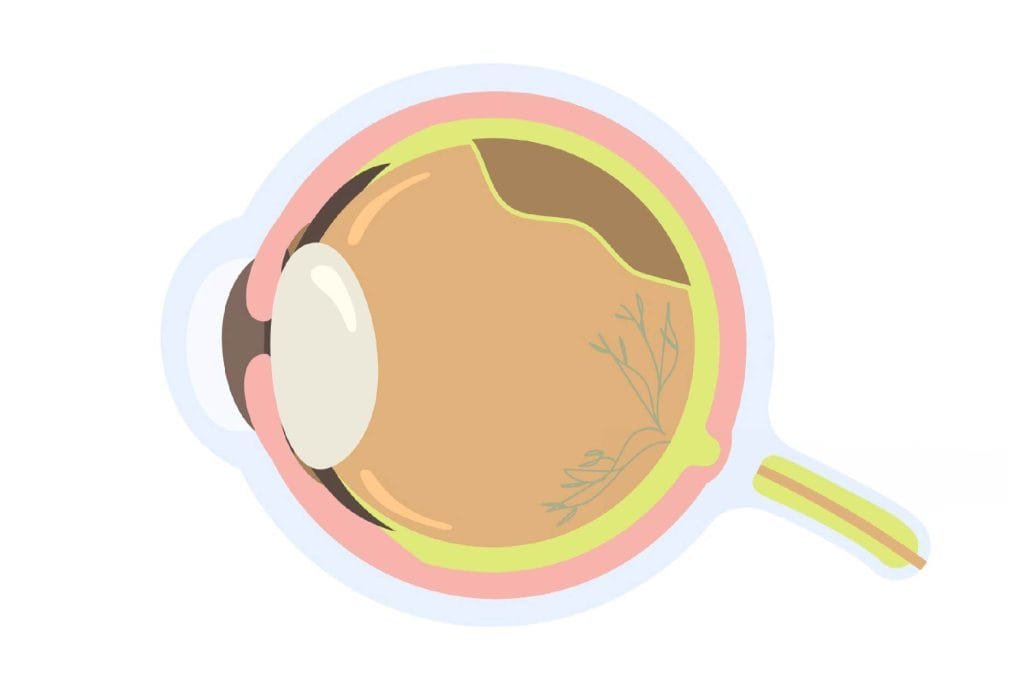 Descolamento de retina em Brasília, representando a importância de reconhecer sinais como flashes de luz e sombra na visão para um diagnóstico e tratamento rápidos.