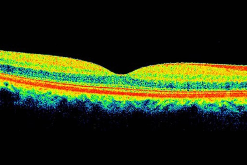 Tomografia da mácula em Brasília, representando a importância de diagnósticos precisos para saúde ocular avançada.